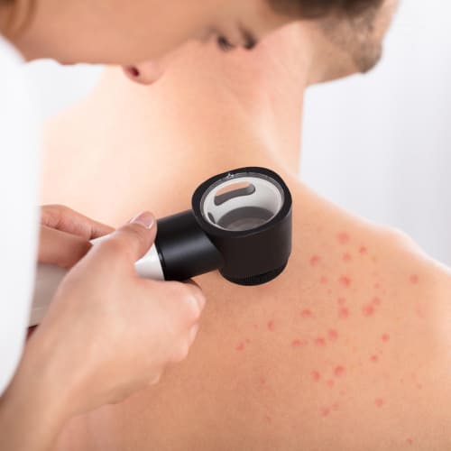 Dermatoscope